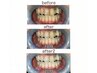 ホワイトニング【再来★白さキープ】高濃度 45分