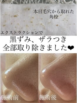 ユヌ(une)/毛穴エクストラクション