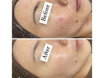 カルディエ(Cardie)/肌質改善　ビフォーアフター