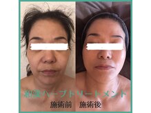 バイオビューティー 神戸本店(Bio Beauty)/ハーブピーリング症例