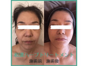 バイオビューティー 神戸本店(Bio Beauty)/ハーブピーリング症例