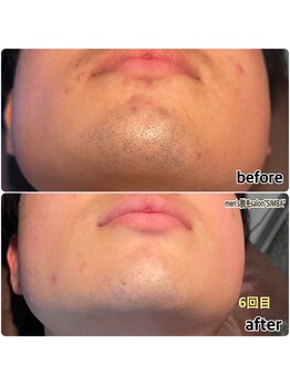 メンズ シンバ(SIMBA)/◯before→after◯