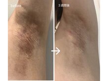 クリアー(CLEAR.)/【Before＆After】ローマピンク