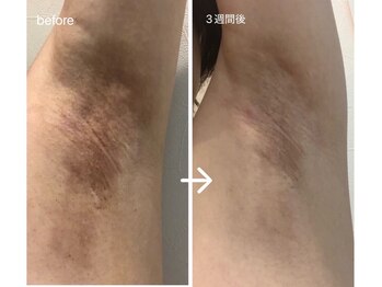 クリアー(CLEAR.)/【Before＆After】ローマピンク