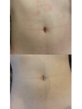 メンズサロン エイチ(H)/お腹脱毛