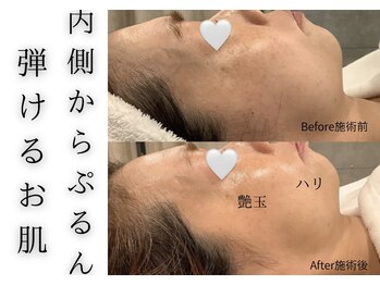 チッチ アフロディーテ(Chicchi Aphrodit)/毛穴洗浄＋ハーブピーリング