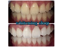 生まれ持った本来の白さを手に入れよう！ホワイトニング/日進市