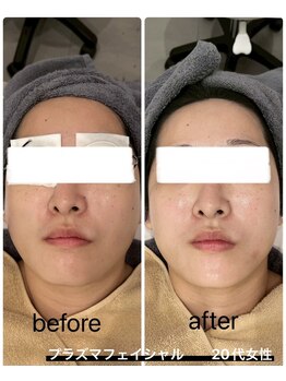 イル 名取店(iru)/プラズマフェイシャル