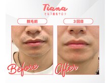 ティアナ(Tiana)/メンズひげ脱毛　Before&After