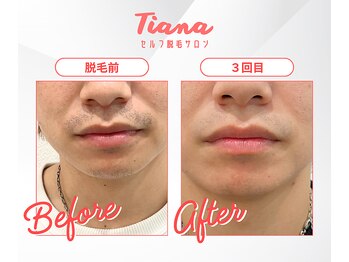 ティアナ(Tiana)/メンズひげ脱毛　Before&After