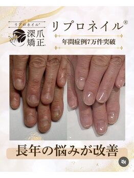 ネイルサロンカリプソ(Nail Salon Calypso 2)の写真/【深爪/噛み爪/むしり爪】手を隠す日常は卒業！自爪ケアで自信の持てる美しい指先へ♪メンズや足の爪も◎