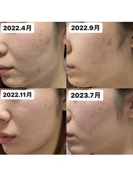 レリール バイ エレクトロ(Rerire by electro)/REVI陶肌トリートメント