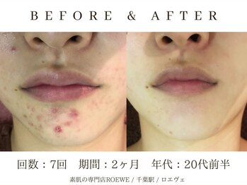 ロエヴェ(ROEWE)/ニキビ改善・毛穴ケア・肌質改善