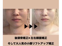 キララ 美容矯正