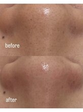 ミュー 自由が丘店(mieux)/◆肌質改善例