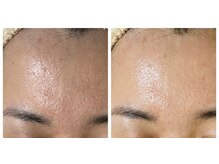 ココ(COCO)/ハーブピーリング/REVI/高知