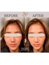 チョコバリ 錦糸町店(chocobari)/小顔×リフトアップ(美容鍼)20代