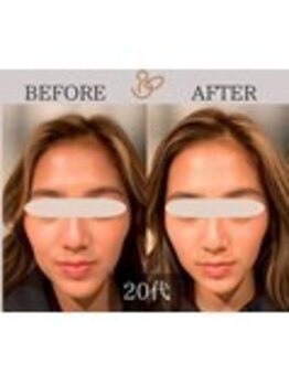 チョコバリ 錦糸町店(chocobari)/小顔×リフトアップ(美容鍼)20代