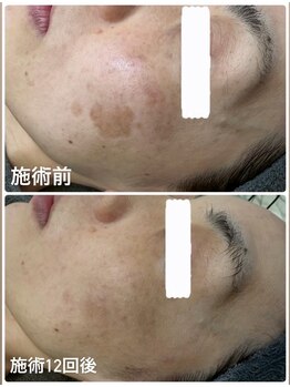 ナナラ/速攻シミケア症例