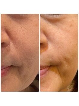 チョチョワンプラス(緒々one+)/たるみ、ほうれい線に光フォト♪