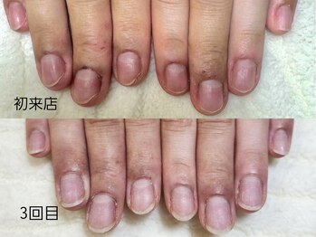 グラシナ なんば店/深爪/自爪育成/フィルイン