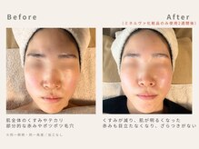 メレ(mele)/30代赤み｜ニキビケア、毛穴