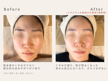 メレ(mele)/30代赤み|ニキビケア、毛穴