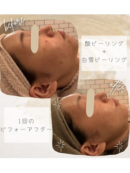 モイ(moi.)/◆Wピーリング◆