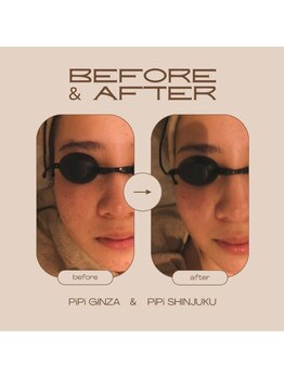 ピピ ギンザ(PiPi GINZA)/速攻小顔！