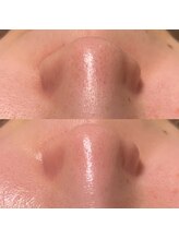 ナチュウル(Natulu)/毛穴洗浄一回でこの効果♪