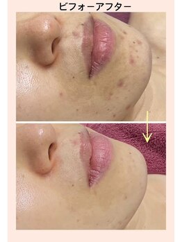 リファイン(REFINE)/大人ニキビケアに！