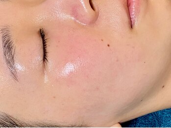 リノルーア(Linolua)の写真/隠す肌から魅せるツヤ肌へ☆繰り返す毛穴悩みやニキビを改善！理想の肌質改善をサポートします。