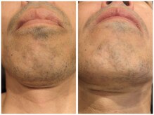 フワリ(Fuwari)/ヒゲ脱毛