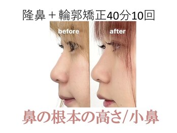 ラプリ 大阪心斎橋店(Raplit)/隆鼻＋輪郭矯正40分10回