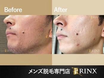 リンクス 岐阜駅前店(RINX)/ヒゲ脱毛《メンズ脱毛RINX》