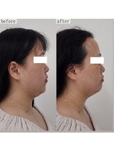 ヴェルシック(Belchic)/驚きの変化と効果をあなたにも