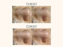 ドリームスパ 武蔵小杉店(DREAM SPA)/毛穴吸引＋引き締めパック＋導入