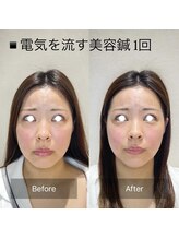 ウル(ulu)/電気を流す美容鍼before、after