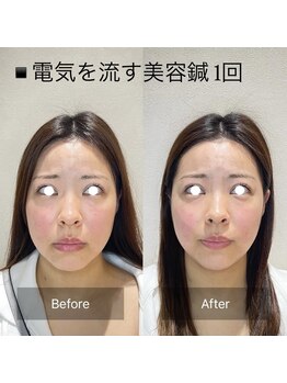 ウル(ulu)/電気を流す美容鍼before、after