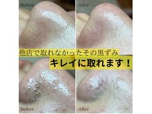 ウィタ(Wita)の雰囲気(皮脂分泌量は人それぞれ。継続することで毛穴レスを目指せます!)