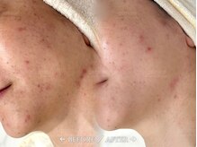 ジェム(gemme)/アンストレス＋ビオフィート