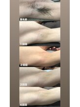 ビューティーサロンレモン(Lemon)/脇脱毛