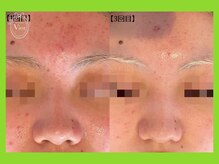 ハーブピーリング 名古屋/韓国水光 ハーブピーリング