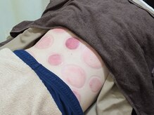 すずらん接骨院/吸い玉　腰