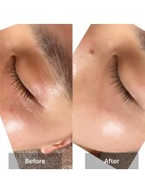 サロン ド アヤ(salon de Aya)/一回施術でシワと肌色の改善