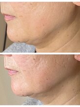 レイール(Reir)/ほうれい線・二重アゴ・たるみ☆