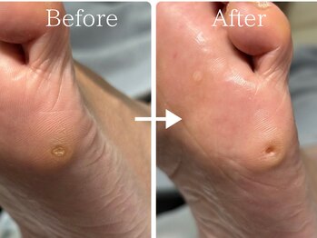 巻き爪補正店 金山店/魚の目・タコ（施術前と施術後）