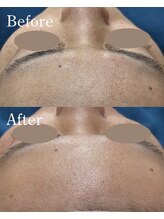 ホワイトワックス 沖縄店(WHITE WAX)/産毛除去でワントーンアップ