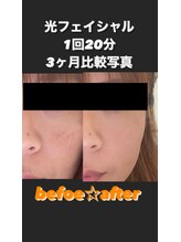 アイピー(I.P)/Before After
