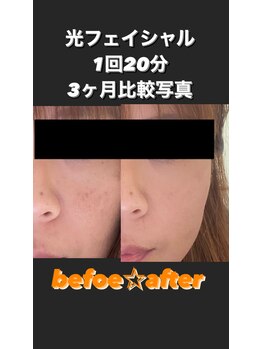 アイピー(I.P)/Before After